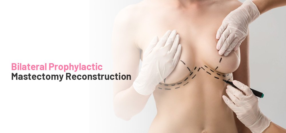 Bilateral Prophylactic Mastectomy Reconstruction